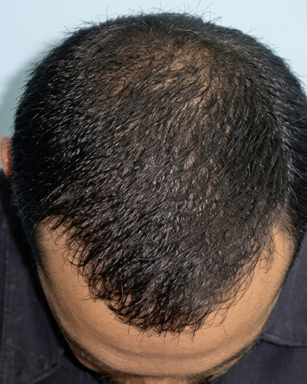 Hair loss treatment after result